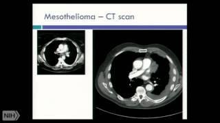 What is mesothelioma?