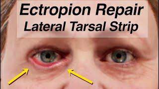 Ektropium-Reparatur mit einem lateralen Tarsalstreifen