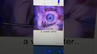 Why did you get LASIK?
