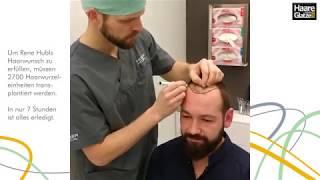 FUE Haartransplantation live (pt 1): Anzeichnen der Haarlinie