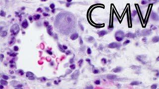 CMV cytomegalovirus infection in skin ulcer (pathology dermpath dermatology dermatopathology)