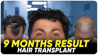 Hair Transplant in Salem | Best Results & Cost of Hair Transplant in Salem