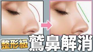 Elimination of eagle nose nasal muscle nasal bone self-care