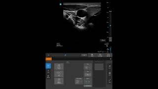 Sonosite ST: Patient Information