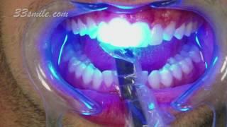 Improving a Patient's Smile with Porcelain Dental Veneers at Cosmetic Dental Associates