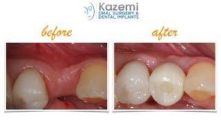 Ridge Expansion with Densah  Osseodensification Burs And Dental Implant with Bone Graft