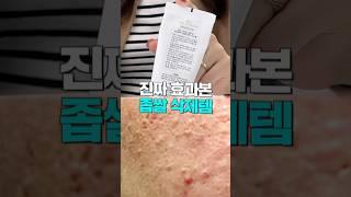 나만 알고 싶은 좁쌀여드름 박멸템진짜 효과본 스킨케어 추천템