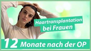 Haartransplantation Frauen Vorher Nachher (12 Monate nach der OP)