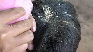 Huge Flake !! Very Dandruff Scratching Big Flakes In My Nephew's Head #41