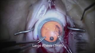 Narrated IMT Surgical Procedure by Sumit Garg MD