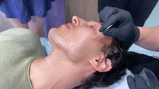 HOW TO GET RID OF ICE-PICK ACNE SCARS | TCA Cross to Face for Deep Acne Craters | Dr. Jason Emer