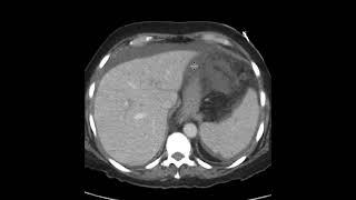 Perforated gastric ulcer