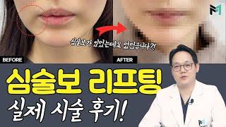 심부볼 제거, 지방흡입 할까? 실리프팅 할까?