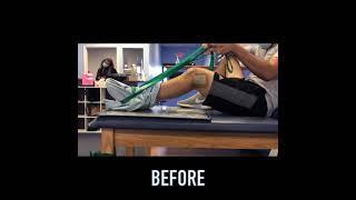 Fractured Femur Progress