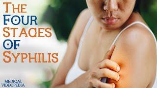 Understanding The Different Stages Of Syphilis