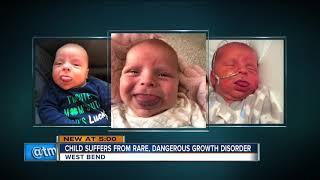 Child suffers from rare, dangerous growth disorder