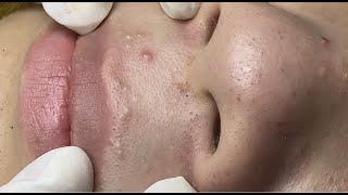 Acne treatment for Nguyen (P3) #HoangMySpa67
