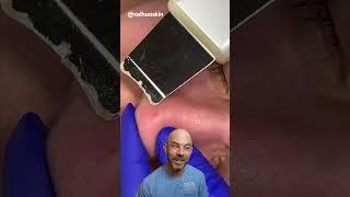 Is this pore spatula treatment worth it? (credit: @@xelhauskin on TT) #doctor #satisfying #viral