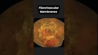 Tractional Retinal Detachment  #ophthalmology#retina