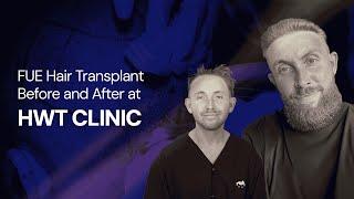 FUE Hair Transplant Before and After at HWT CLINIC