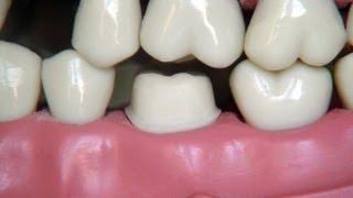 Full metal crown preparation - for dental students