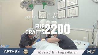 2200 Grafts FUE ARTAS iX Robotic Hair Restoration at Hair By Dr. Max, Orlando, Florida