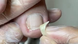 Curved nail that stab the toe | He Pedicure