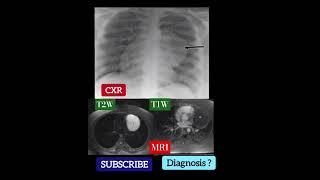 Diagnosis ? CXR & MRI T1W & T2W - Practical Case - Radiology