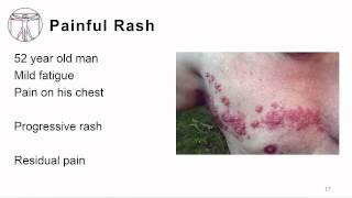 VZV: Pathogenesis & Immune response