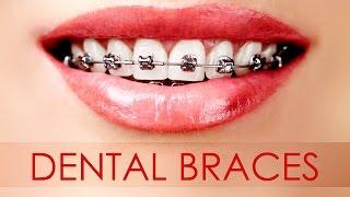 Different Types of Dental Braces for Your Teeth