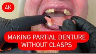 MAKING PARTIAL DENTURE WITHOUT CLASPS- ALL STEPS AND INSERTION 4K #waxbae