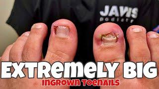 BILATERAL INGROWN TOENAIL