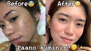 Paano ako Kuminis| How to achieve clear skin | Acne Free| Pimples free |Mavisse Mamba