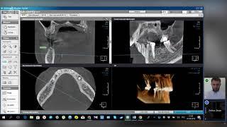 Компьютерная томография зубов в спб