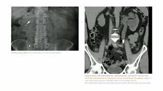 KMLE 강의 시리즈 -  Nephrology, 21) ADPKD, Urinary stone