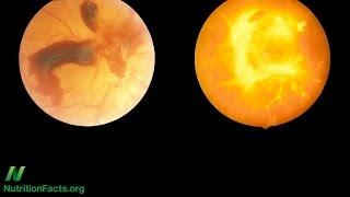 Can Diabetic Retinopathy Be Reversed?