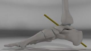 Over Pronation & Supination Motion Biomechanics of the Subtalar Joint Explained