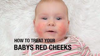 How to treat your baby's red cheeks?