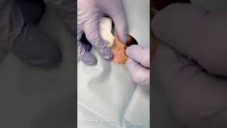 Dermatologist Pops A Zit #shorts #pimplepopper | CONTOUR DERMATOLOGY