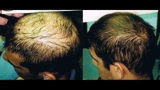 Platelet Rich Plasma for Hair Loss | With or Without Hair Transplant