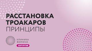 универсальная расстановка троакаров на любую операцию в малом тазу