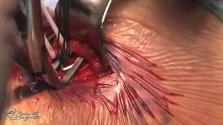 TSFL for great saphenous vein disconnection