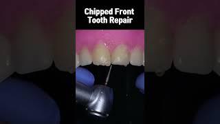 Chipped Front Tooth Repair - Composite Resin #shorts