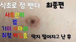 점빼고 난후/쥐젖 비립종/식초로점뺀다/딱지떨어진후/사후관리