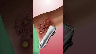 #asmr Remove armpit hair & tick from infected armpit #animation #beauty #cleaning