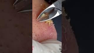 Skincare | Blackheads Removal #485 #tweezers skincare #blackheads blackheads