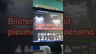 Presented as Parotid swelling on doing USG : Pleomorphic Adenoma