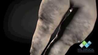 Lipedema Treatment New York, NJ | Animation By NYC Surgical Associates