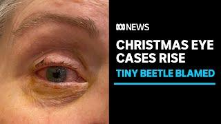 Christmas eye cases on the rise, caused by tiny beetle you won't see coming | ABC News