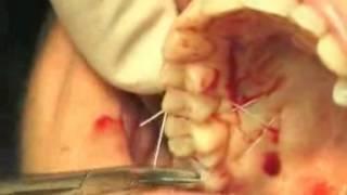 Mucogingival Surgery in Periodontics - Allen Modified Tunnel